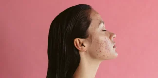 Women Can Tackle Hormonal Acne